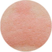 Allergic Skin Allergic Skin