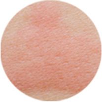 Allergic Skin